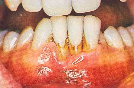 Nicotine Teeth