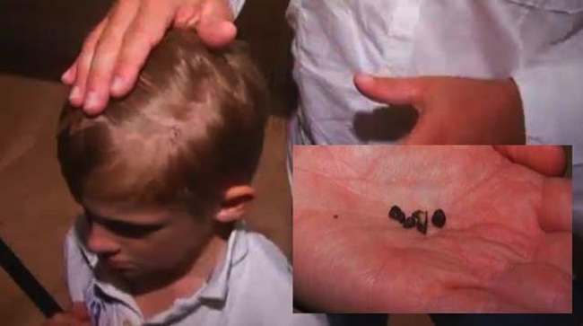 meteor head wound Meteorite Hits Boy On Head