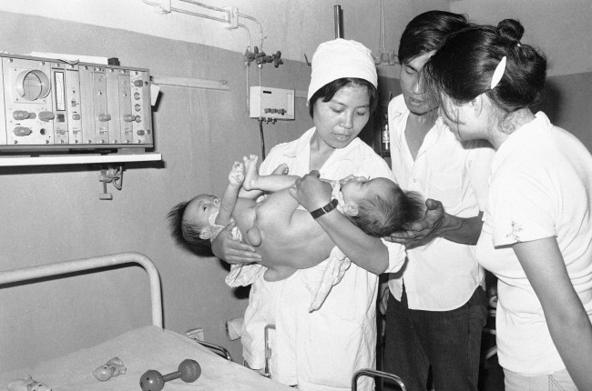 Year-old conjoined twins being cared for at HanoiÂs Viet-Duc hospital, a center for treating deformed children and others who may have been affected by exposure to the defoliant Agent Orange, employed by U.S. forces during the war, are shown May 30, 1982. The Vietnamese admit they have no firm proof yet of the relationship between the chemical and adverse health. The conjoined twins were not cited as examples of the agentÂs possible damage to humans. 