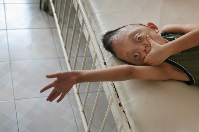 Nguyen Xuan Minh, age 6, rests in his bed at the "Peace Village" of Tu Du hospital in Ho Chi Minh City Friday, May 25, 2007. According to hospital staff, the boy is suffering from physical deformities suspected to have been caused by his parents' exposure to dioxin in the chemical defoliant Agent Orange. 