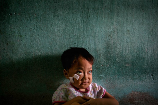 *Nguyen Thi Kieu Nhung sits inside her family home next to the Danang airbase in Danang, Vietnam, in this May 21, 2007, file photo. The girl was born with physical deformities, including twisted limbs, a misshapen head, and protruding eyes suspected by local health officials to have been caused by dioxin in the chemical defoliant Agent Orange. More than 30 years after the Vietnam War ended, the poisonous legacy of Agent Orange has emerged anew with a scientific study that has found extraordinarily high levels of health-threatening contamination at the former U.S. air base at Danang. 