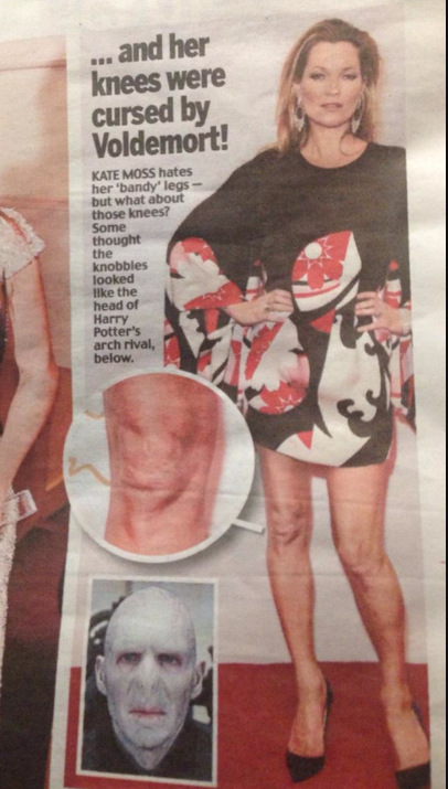 BREAKING. Kate Moss's knees have been 'cursed by Voldemort'. Daily Mail has the scoop.