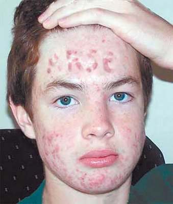 teenage acne arse Teenagers Face Acne Spells ARSE TEENAGER Sam Cummings has