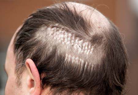 wanker hair Hair Transplant Surgeon Carves WANKER Onto Mans Head